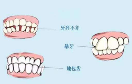 种植牙有什么优缺点（人工种植牙的优缺点）(图1)
